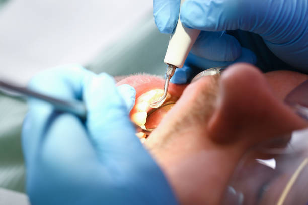 Best Chipped Tooth Repair Near Me  in Minerva, OH