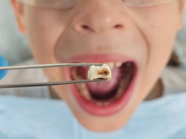 Best Dentist for Tooth Abscess  in Minerva, OH